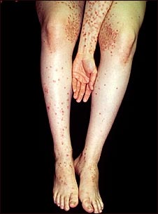 Dermatitis herpetiforme en el brazo y las piernas