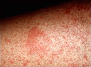 Primer plano del eczema atópico