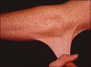 Síndrome de Ehlers-Danlos o hiperelasticidad de la piel