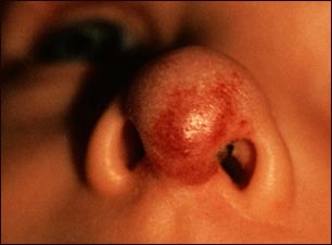 Hemangioma en la cara (nariz)
