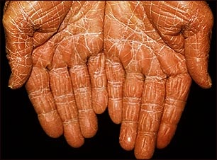 Pitiriasis rubra pilaris en las palmas de la mano