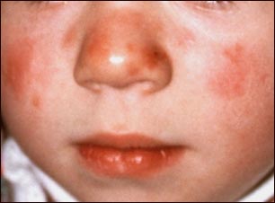 Lupus discoide en el rostro de un niño