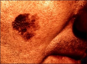 Cáncer de piel: primer plano del melanoma léntigo maligno