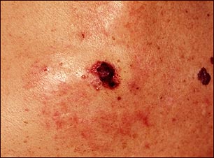 Cáncer de piel: primer plano del melanoma de nivel IV