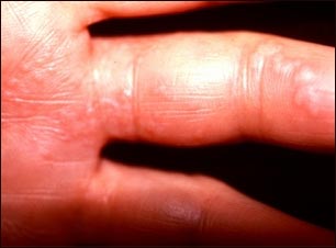 Herpes zoster (culebrilla) en la mano y dedos