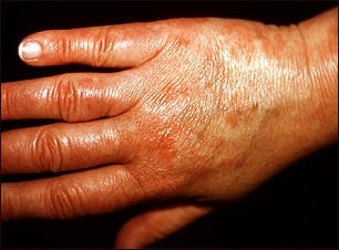Vasculitis urticarial en la mano