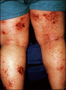 Dermatitis atópica de las piernas