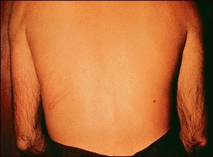 Estrongiloidiasis, erupción progresiva en la espalda