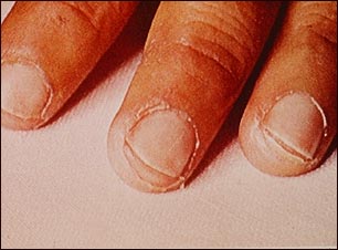 Enfermedad de Kawasaki, exfoliación de las puntas de los dedos