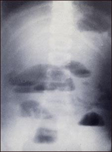 Radiografía de obstrucción del intestino delgado