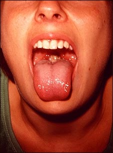 Mononucleosis, boca