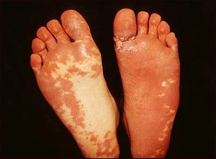 Síndrome de Sturge-Weber; plantas de los pies