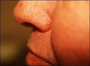 Carcinoma de célula basal en la nariz