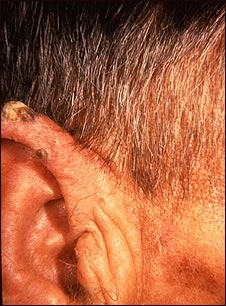 Queratosis actínica en el oído