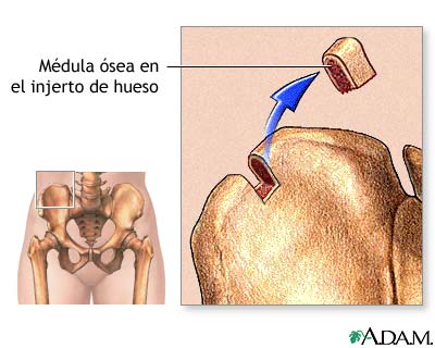 Médula ósea de la cadera