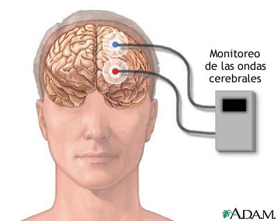 Monitor de ondas cerebrales