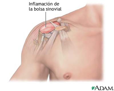 Bursitis del hombro
