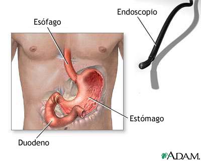 Endoscopia gástrica