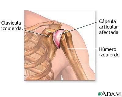 Inflamación de la articulación del hombro