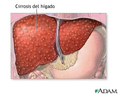 Cirrosis del hígado