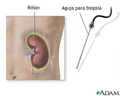 Biopsia renal