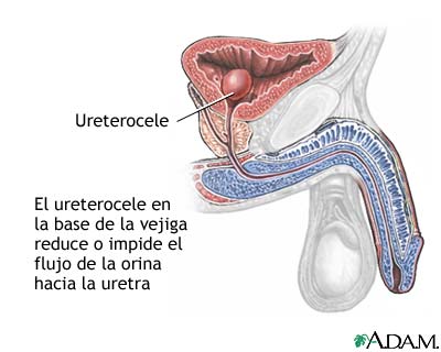 Ureterocele