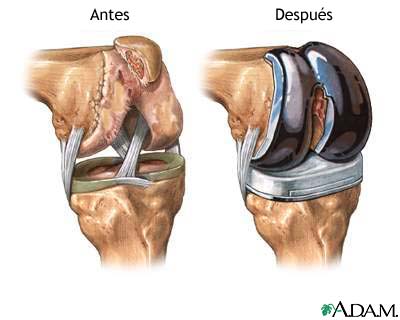 Prótesis de reemplazo de la articulación de la rodilla