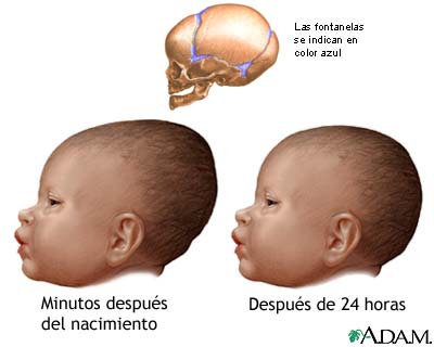 Amoldamiento de cabeza del recién nacido