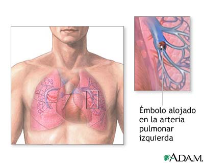 mbolo pulmonar