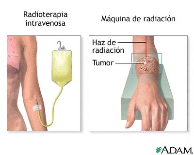 Terapia de radiación