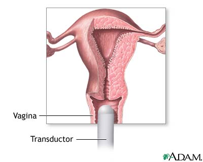 Ultrasonido transvaginal