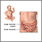 Obstrucción intestinal - Serie