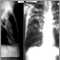Tuberculosis avanzada, radiografía de tórax