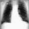 Nódulo pulmonar; vista frontal en placa de rayos X de tórax