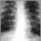 Sarcoidosis, estado II - radiografía de tórax