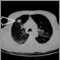 Masa pulmonar, lóbulo superior derecho - Tomografía computarizada