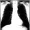 Cáncer bronquial - radiografía de tórax