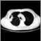 Pulmón con cáncer de células escamosas - Tomografía computarizada