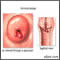 Pólipos cervicales