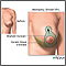 Elevación de mamas (mastopexia) - Serie
