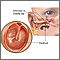 Infección del oído medio
