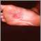 Dermatitis en la planta del pie por níquel
