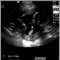 Ultrasonido de un feto normal; brazos y piernas