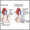 Arteria coronaria izquierda anómala