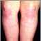 Dermatomiositis en las piernas