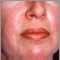Dermatomiositis; erupción heliotrope en la cara