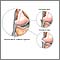 Lesión del ligamento colateral lateral