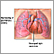 Hipertensión pulmonar primaria